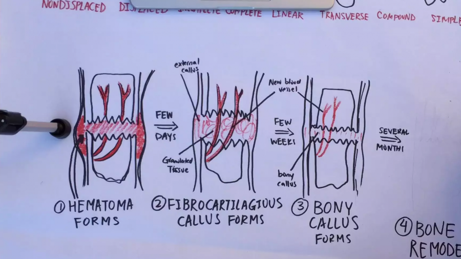 The process of healing bone fractures. Credit: Rachel Chang // The Foothill Dragon Press